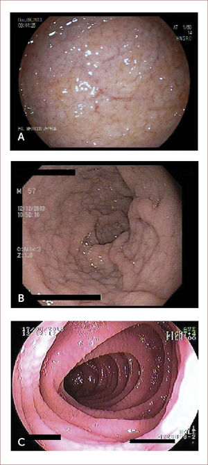 IMÁGENES ENDOscópicas de duodeno Imágenes endoscópicas de duodeno donde se aprecian nodularidad, adelgazamiento y visualización de vasculatura submucosa (A), marcada nodularidad con patrón empedrado (B), y aspecto festoneado de la mucosa (C). Las imágenes corresponden a pacientes tratados por los autores.