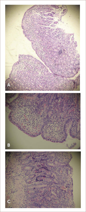 imágenes histológicas de biopsias duodenales Imágenes histológicas de biopsias duodenales de pacientes con enfermedad celíaca (tinción con hematoxilina-eosina). A. Atrofia total de las vellosidades. B. Linfocitos intraepiteliales >40 por cada 100 enterocitos. C. Notoria hiperplasia de las criptas.