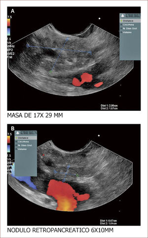 Masa de cabeza de PÁncreas en un hombre de 47 años Compromete vía biliar y tiene múltiples adenopatías. Se ve también involucrado el Wirsung. La patología reportó un adenocarcinoma mal difereciado del páncreas. En la foto A se ve la masa y en está igual que en la de la derecha se ve que contacta e invade la porta. En la B se ve un nódulo grande entre la porta y la lesión de la cabeza. Con estos hallazgos más la clínica del paciente el grupo de cirugía decidió manejo paliativo. Colocamos en vía biliar un stent autoexpandible no recubierto. El paciente está aún en seguimiento. (imagen de Unión de Cirujanos SAS – Lázaro Arango (Autor), se publica con permiso).