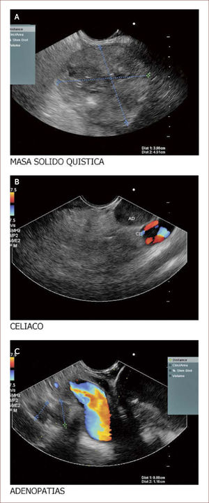 Paciente de 60 años con masa que emerge de la cabeza del páncreas y llega al borde inferior del hígado. En la imagen A se ve la masa. En la B la aorta a nivel del plexo celíaco y una gran adenopatía a este nivel. En la C se ven los vasos portales y adenopatías varias a este nivel. Esta paciente se llevó a punción y se reportó un sarcoma mal diferenciado. La paciente no fue llevada a ningún procedimiento quirúrgico. (Imagen de Unión de Cirujanos SAS – Lázaro Arango (Autor), se publica con permiso).