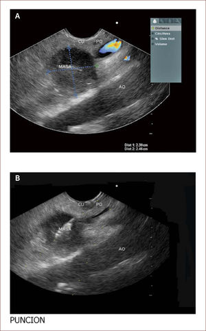Esta es la paciente anterior. En la A se ve claramente la aorta señalada como AO y la gran adenopatía – En la B se ve la punción de dicha masa con aguja fina (FNA).