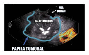 Tumor de papila extendido al páncreas, con calcificaciones.