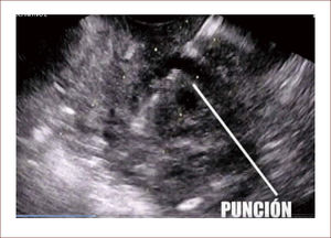 Punción de la masa desde duodeno con aguja 22G.