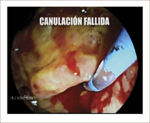 El tumor visto por CPRE y canulación fallida desde el duodeno.