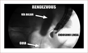 Vía biliar contrastada, Endosonógrafo y paso de la guía. Esta paso al duodeno.
