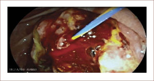 Guía pasada a duodeno.