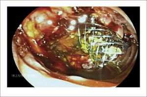 Luego se completó la CPRE y se puso este stent autoexpandible para drenaje.