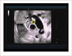 Endosonografía radial en un paciente con sospecha de litiasis del colédoco Se ve arriba el hígado y en la parte central, una imagen alargada hipoecoica (negra) que corresponde al conducto biliar y en su interior se aprecian dos cálculos.