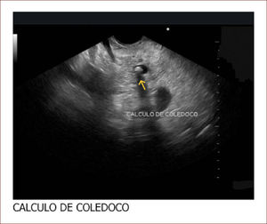Paciente con cuadro de pancreatitis aguda El paciente con ecografia y además imágenes que no mostraban compromiso de la vía biliar, ni de la vesícula. La resonancia magnética mostró vía biliar normal y descartó cálculos. El EUS mostró un cálculo pequeño menor de 3mm. Fue llevado a CPRE en forma temprana y el cuadro mejoró muchísimo. Hay que notar que la Resonancia a veces no detecta cálculos menores de 3mm.