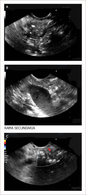 Paciente de 29 años. Debutó con diabetes y dolor de abdomen. Historia de alcoholismo y tabaquismo. Dentro de los estudios le envían para EUS y vemos lo siguiente. En la imagen A se observan calcificaciones y bandas fibrosas del parénquima del páncreas. Un páncreas que es irregular. En la B se ven las misma calcificaciones y ramas secundarias. En la C se ve un conducto de Wirsung dilatado y lleno de cálculos. Todo lo anterior lo diagnostica como una pancreatitis crónica, ya que cumple con más de 5 criterios de Rossemont. Por medio de esta imagen se decidió manejo médico con cuidado nutricional y enzimas pancreáticas a dosis adecuadas. El paciente tiene Ca 19-9 normal. Su dolor se ha controlado. En caso de reactivación de su cuadro sintomático se hará biopsia por EUS. Por la dilatación del conducto y la presencia de cálculos podría ameritar intento de manejo endoscópico o de una cirugía derivativa de su conducto principal.