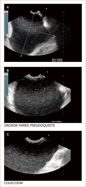 Paciente con seudoquistre del páncreas posterior a cuadro de pancreatitis aguda. La paciente tuvo dolores que no fueron rotulados como tal y los manejaron en el campo (Fundo), como algo digestivo. Al consultar en la capital a una clínica encuentran en la TAC esta lesión. En la imagen A se ve la medición del tamaño del quiste y en la imagen B el grosor de la pared de 6mm. En la C a la izquierda el contenido líquido con pocos detritus. Fue llevada a drenaje y colocacion de stent.