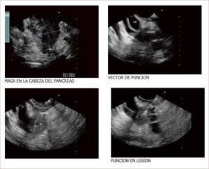 Lesión de cabeza de páncreas en un hombre de 67 años. La lesión es sólido quística. En la imagen de arriba a la izquierda se ve que la lesión mide 30mm es de ecos mixtos y con componente sólido y líquido. En la imagen de arriba a la derecha se ve la vía biliar y la lesión comprimiéndola. En la imagen de abajo a la izquierda se ve la lesión con calcificaciones, nódulos al lado. En la de abajo a la derecha se ve la punción de la que salió material mucoide y algunos fragmentos de tejido que fueron leídos como acinos normales. Por imágenes y por el tipo de lesión se pensó en IPMN. Tiene características quirúrgicas, como son componente sólido en la lesión, quiste mayor de 30mm, nódulos y como se verá en la imagen siguiente un Wirsung mayor de 10mm y tortuoso con nodulaciones.
