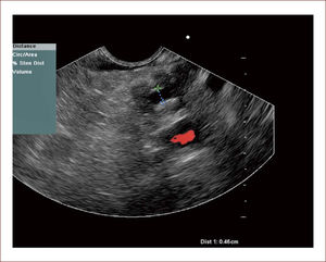 En esta se ve el Wirsung del mismo paciente dilatado y tortuoso, con nodulaciones y la masa pegada a la porta. El paciente fue llevado en otra ciudad a cirugía por un grupo de Páncreas y se confirmaron los hallazgos anteriores y tenía criterio de no resecabilidad por gran plastrón a nivel portal.