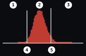 Amplitud de distribución de hematíes Contador hematológico Advia 2120i. Siemens. Las muestras normales tienen una distribución en forma de campana con un canal modal de entre 60 fl y 120 fl. El volumen corpuscular medio (VCM) y la amplitud de distribución de hematíes (IDH) se determinan a partir de este histograma. El VCM es la media del histograma Volumen HEM. La IDH es el coeficiente de variación de la población. El factor de calibración VCM se ha aplicado a los datos mostrados.