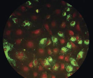 Inmunofluorescencia indirecta Monocapa de células HEp-2 infectadas con virus respiratorio sincicial. Se evidencia la presencia de la proteína F viral en membranas y citoplasma de las células infectadas, gracias a la marcación con anticuerpo secundario conjugado con molécula fluorescente. Foto gentileza de Dr. Luis Fidel Avendaño.