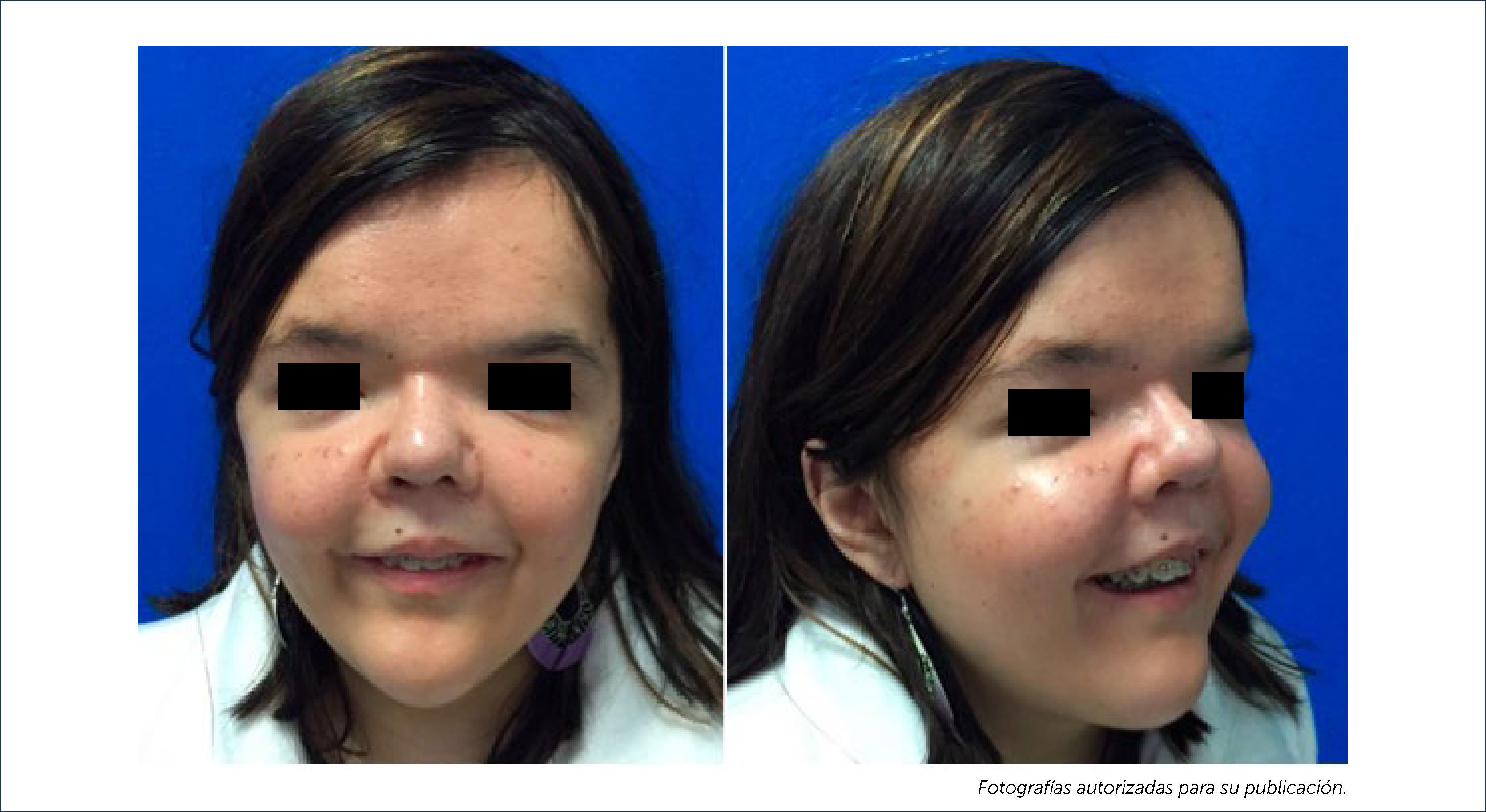 DISTRACCIÓN ÓSEA DEL TERCIO MEDIO FACIAL EN MALFORMACIONES CRÁNEO