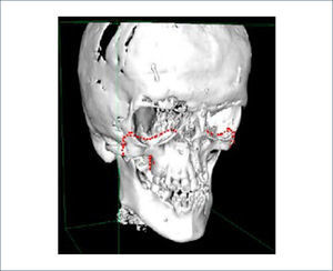 TOMOGRAFÍA COMPUTADA DE MACIZO FACIAL CON RECONSTRUCCIÓN 3D En línea punteada osteotomía planificada.