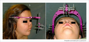 FOTOGRAFÍAS DE DISTRACCIÓN DEL TERCIO MEDIO FACIAL CON RED.