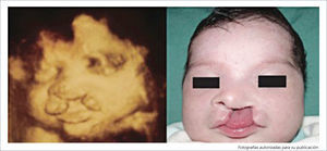 PACIENTE CON DIAGNÿSTICO PRENATAL DE FISURA LABIAL IZQUIERDA Y LUEGO DE SU NACIMIENTO.