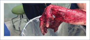 Extremidad superior gravemente lesionada. Degloving de dorso, palma y quinto dedo.