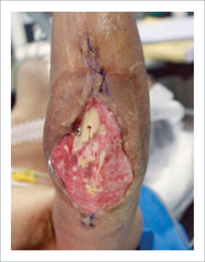 FRACTURA EXPUESTA DE CODO.