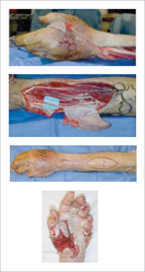 COLGAJO INTERÓSEO POSTERIOR PARA RECONSTRUCCIÓN DEL PRIMER ESPACIO. IMÁGENES PREOPERATORIAS Y ELEVACIÓN DEL COLGAJO.