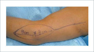 DISEÑO DEL COLGAJO LATERAL DEL BRAZO.