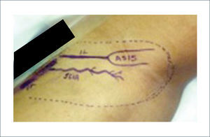 DISEÑO DEL COLGAJO INGUINAL.