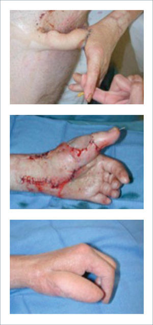 DISEÑO Y ELEVACIÓN DEL COLGAJO INGUINAL PARA COBERTURA DEL PULGAR. IMÁGENES PREOPERATORIA E INTRAOPERATORIAS.