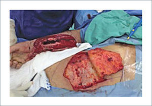 ELEVACIÓN DEL COLGAJO PEDICULADO ABDOMINAL PARA COBERTURA DE ANTEBRAZO.