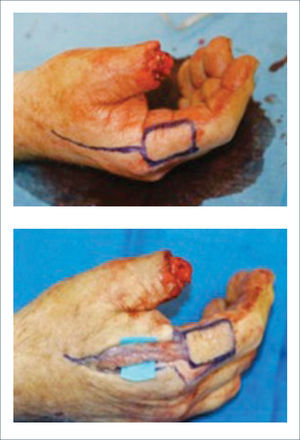 DISEÑO Y ELEVACIÓN DEL COLGAJO DE ARTERIA DORSAL METACARPIANA PARA COBERTURA DEL EXTREMO DISTAL DEL PULGAR.
