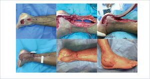 COLGAJO PERFORANTE DE ARTERIA PERONEA EN HÉLICE (PROPELLER FLAP) Colgajo perforante de arteria peronea en hélice (propeller flap), para cobertura de defecto de tobillo y pie, por necrosis y dehiscencia de abordaje para reducción y osteosíntesis de fractura de calcáneo. Se realizó marcación con doppler de perforantes distales de arteria peronea, y diseño de isla de piel (arriba izquierda). Mediante abordaje anterior y disección subfascial se exponen perforantes mediante disección retrógrada (arriba centro). En este caso se escogió la perforante distal. Una vez completa disección de la perforante, se elevó la isla de piel (arriba derecha). Tras rotar en 180° la isla cutánea, con eje en la perforante, se cubrió el defecto, con cierre primario de la zona dadora (abajo izquierda). Evolución post operatoria visión posterior y lateral de tobillo derecho (abajo centro y derecha)