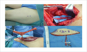 DISEÑO Y ELEVACIÓN DE COLGAJO LIBRE ANTEROLATERAL DE MUSLO Marcación con doppler de perforantes anterolaterales del muslo izquierdo (arriba izquierda). Disección retrógrada de perforante y de rama descendente de arteria circunfleja femoral lateral, se observa el nervio del vasto lateral preservado y disecado sobre el pedículo vascular (arriba derecha). Isla de piel elevada pediculada en perforante (abajo izquierda). Colgajo en la mesa operatoria luego de la sección del pedículo, se destaca su largo pedículo vascular (abajo derecha).