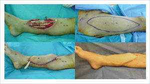 COBERTURA DE FRACTURA EXPUESTA DE PIERNA CON COLGAJO LIBRE ANTEROLATERAL DE MUSLO Fractura expuesta de pierna derecha, con reducción y osteosíntesis interna (clavo endomedular), defecto de cobertura tercio distal (arriba izquierda). Diseño de colgajo anterolateral muslo derecho (arriba derecha). Cobertura del defecto con colgajo anterolateral de muslo pediculado en vasos tibiales anteriores (abajo izquierda). postoperatorio a los seis meses (abajo derecha).