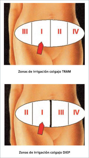 . ZONAS DE IRRIGACIÓN Holm et al. Perfusion zones of the DIEP flap revisited. A Clinical Study. PRS 2006.