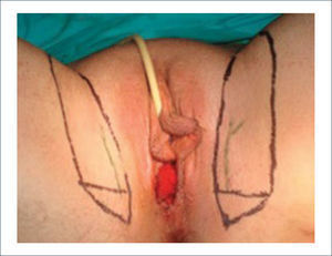 SINGAPORE FLAP BASADO EN LA ARTERIA LABIAL POSTERIOR QUE ES RAMA DE LA ARTERIA PUDENDA INTERNA.