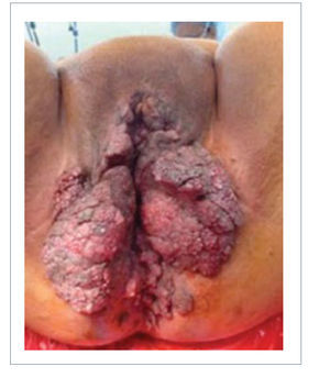 MUJER CON CONDILOMATOSIS POR VIRUS PAPILOMA.