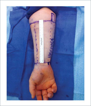 MARCACIÓN PRE-OPERATORIA DEL PRIMER TIEMPO QUIRÚRGICO (PRELAMINACIÓN URETRAL) EN EL ANTEBRAZO.