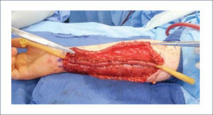 PRELAMINACIÓN URETRAL.