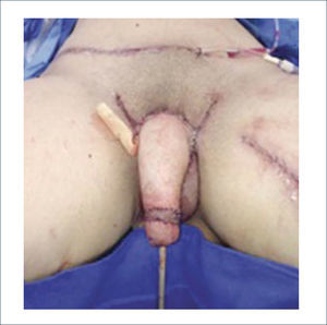 POST OPERATORIO INMEDIATO DE RECONSTRUCCIÓN TOTAL DE PENE.