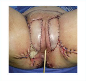 RESULTADO POST OPERATORIO INMEDIATO DE RECONSTRUCCIÓN DE LABIOS MAYORES UTILIZANDO COLGAJOS ABDOMINALES.