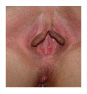 AGENESIA VAGINAL.