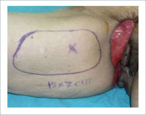 COLGAJO MEDIAL DE MUSLO.