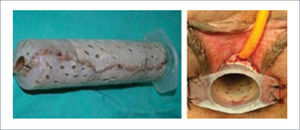 PROCEDIMIENTO DE ABBE-MCINDOE PARA RECONSTRUCCIÓN VAGINAL SE UTILIZÓ UNA JERINGA ENVUELTA EN INJERTOS DE PIEL LUEGO DE CREAR UN ESPACIO PARA SU COLOCACIÓN ENTRE EL RECTO Y LA VEJIGA.