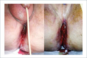 CÁNCER ESCAMOSO AVANZADO ANAL.