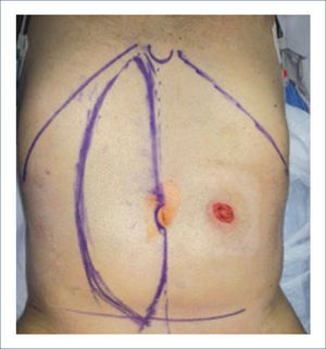 MARCACIÓN DE PALETA CUTÁNEA VERTICAL DEL COLGAJO VRAM SE OBSERVA COLOSTOMÍA TERMINAL EN HEMIABDOMEN IZQUIERDO.