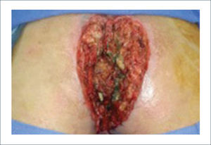 VISIÓN POSTERIOR LUEGO DE LA RESECCIÓN ONCOLÓGICA.