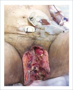 HOMBRE DE 65 AÑOS LUEGO DE RESECCIÓN DE GANGRENA DE FOURNIER.