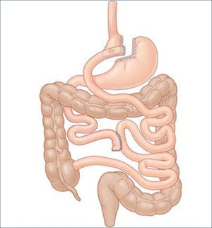 BYPASS GÁSTRICO EN Y-ROUX Schauer P, Brethauer S. Weight loss surgery: state of the art. Rubin P, Matarasso A. Aesthetic Surgery After Massive Weight Loss. 1ed. Philadelphia, PA. USA. Saunders, Elsevier. 2007. Cap 1, pág 3.