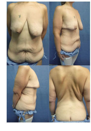 FOTOGRAFÍAS PREOPERATORIAS DE PACIENTE CON BAJA DE PESO DE 60KG.